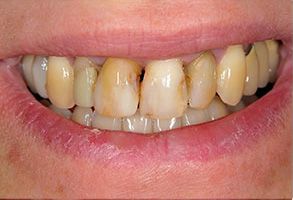 The image shows a close-up of a person s mouth with yellowed teeth, revealing signs of dental decay and poor oral hygiene.